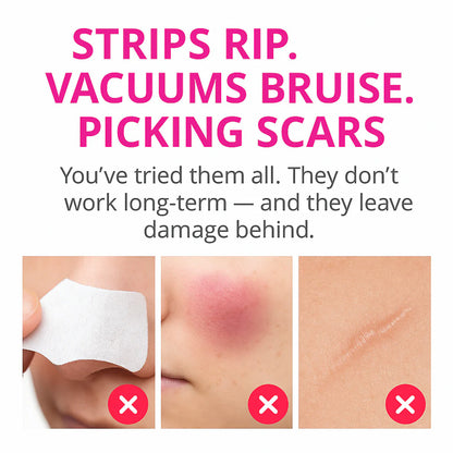 Facital Pore Remover